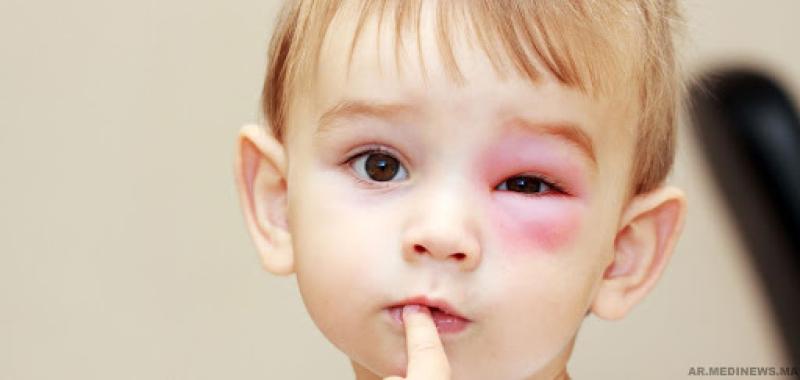 ماذا تعرفين عن أسباب تورم العين عند طفلك؟