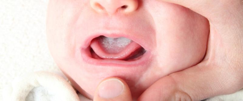 أسباب فطريات الفم عن الاطفال الرضع