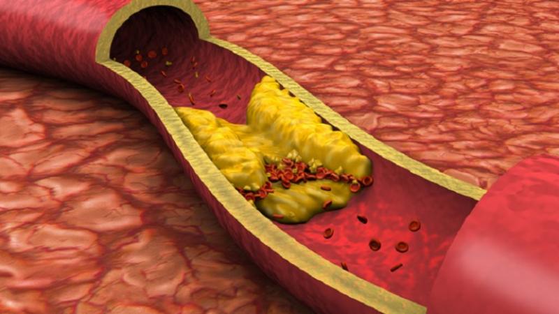 الكوليسترول الضار.. مخاطره الصحية وكيفية مواجهته