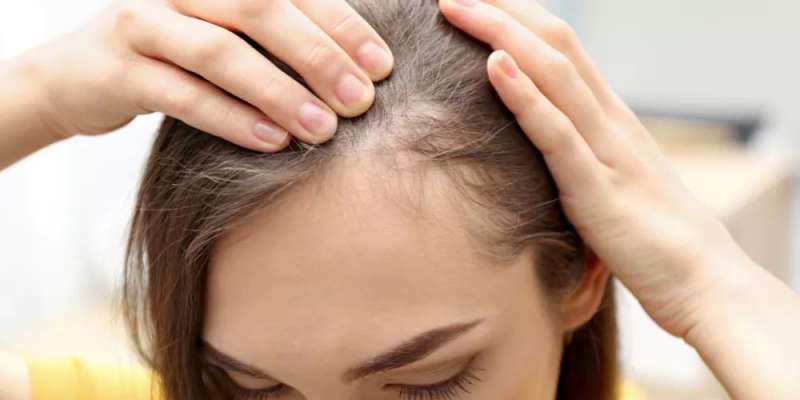 علاج تساقط الشعر الوراثي بالمينوكسيديل