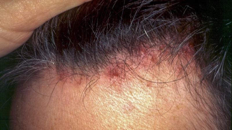 أعراض التهاب بصيلات الشعر