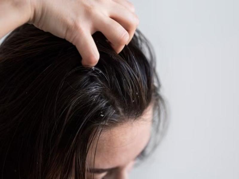 5 طرق لحماية الشعر من القمل