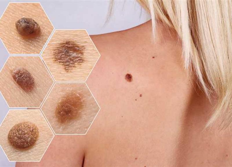 اكتشاف جديد قد يساعد في تطوير علاج لسرطان الجلد