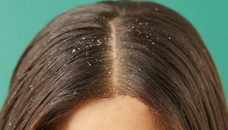 3 طرق للتخلص من قشرة الشعر بشكل طبيعي