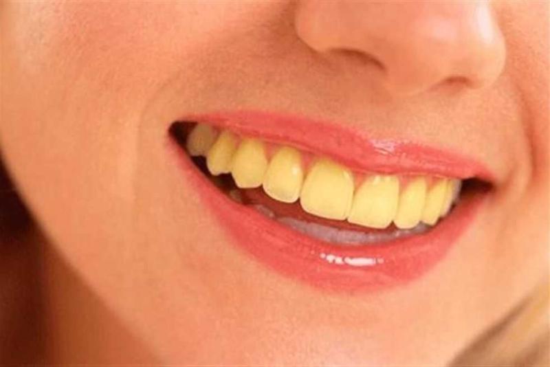طرق علاج اصفرار الأسنان