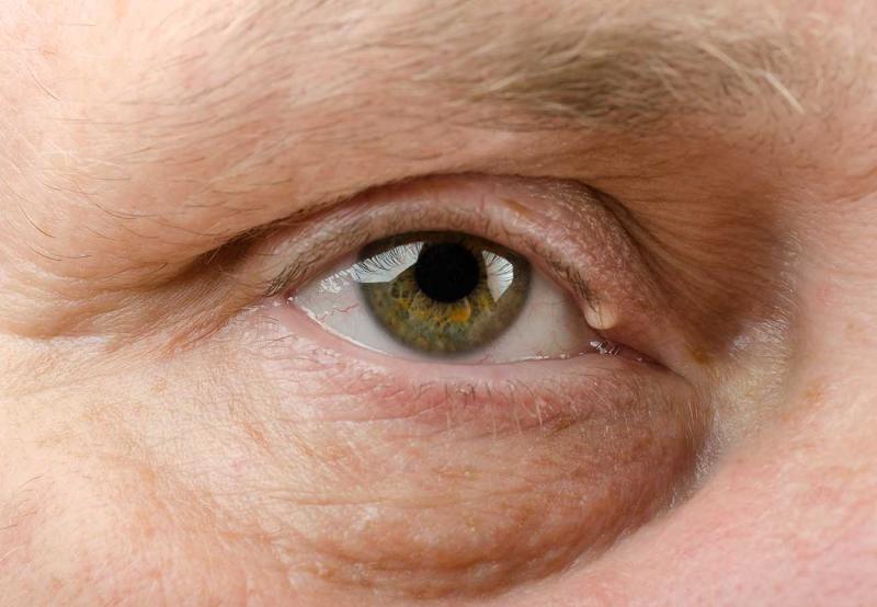 علاجات منزلية لتقليل ظهور الدهون حول العين