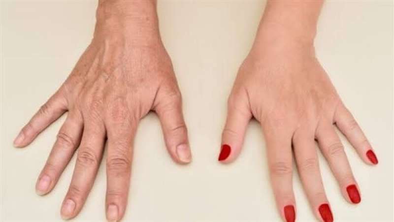وصفات طبيعية لعلاج تجاعيد اليدين
