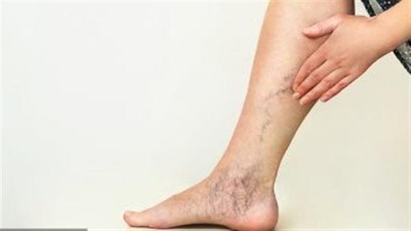 تغيرات في جلد الساقين علامة على ارتفاع نسبة الكولسترول