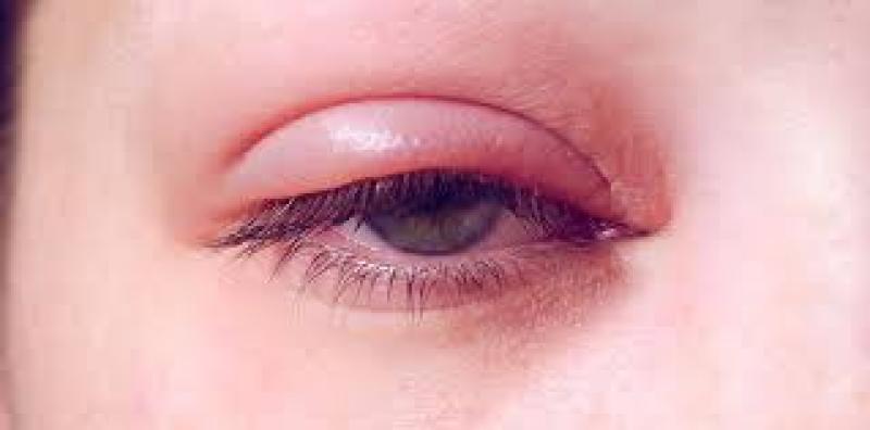 أعراض وأسباب غير شائعة لالتهابات جفن العين