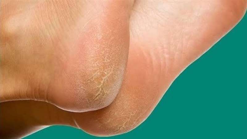 الجلد على القدمين يشير إلى الإصابة بسرطان المريء