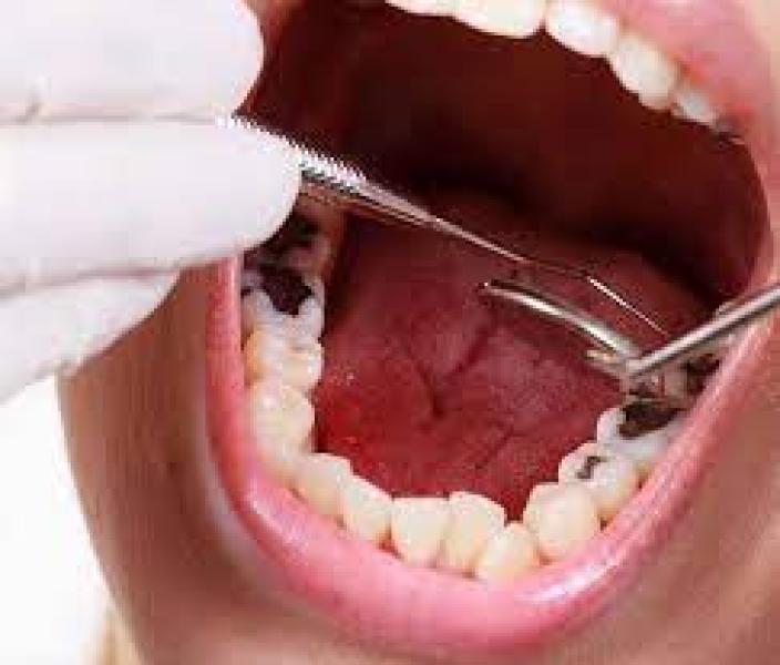 يؤدي إلى مضاعفات صحية خطية.. طبيبة تحذر من إهمال صحة الأسنان