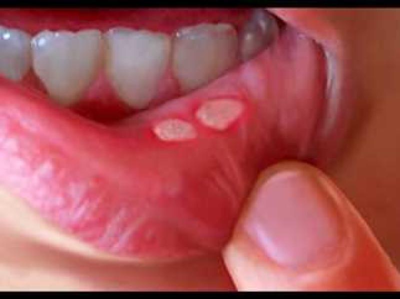علامات ظاهرة وعوامل تزيد فرص الإصابة بتقرحات الفم والشفاه