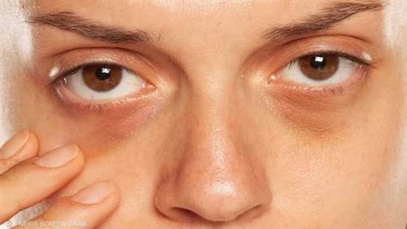 8 أسباب لظهور الهالات السوداء تحت العينين