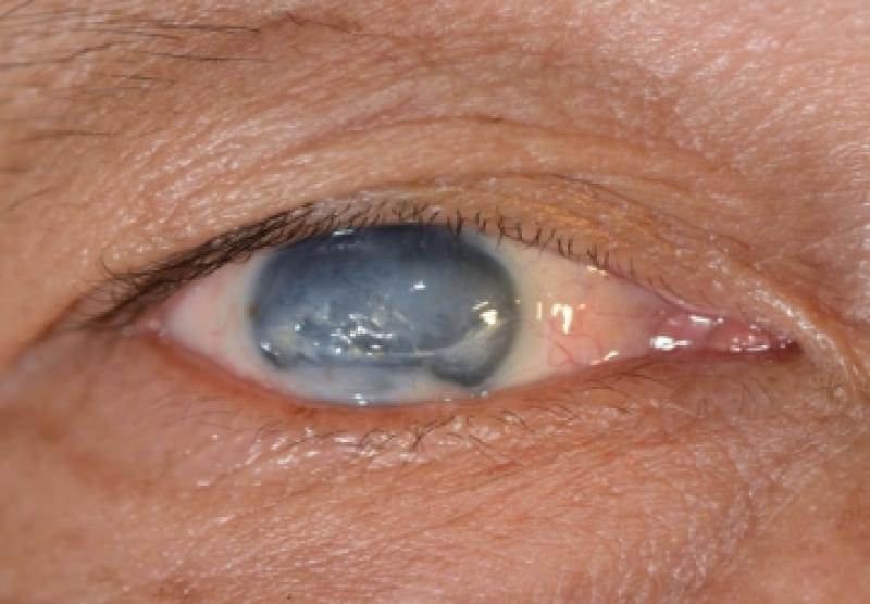 3 علاجات لمواجهة سارق البصر الصامت