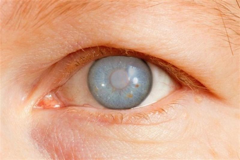 معلومات عن مرض الجلوكوما.. ”يصيب العين”