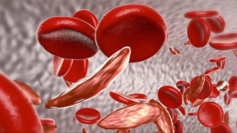 فقر الدم.. أعراض وأسباب الأنيميا وطرق الوقاية