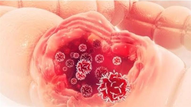5 حيل سحرية تحمي الأمعاء من أمراض خطيرة