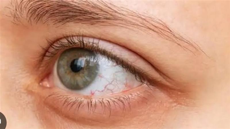 طبيبة تكشف مفاجأة حول أصحاب العيون الملونة وعلاقتهم بسرطان الجلد