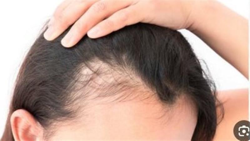 طرق طبيعية لتحفيز نمو بصيلات الشعر