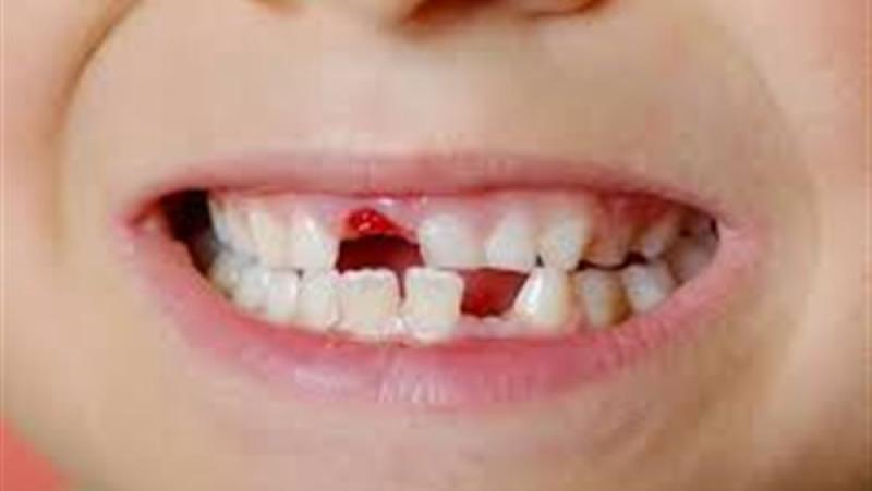 أسباب تأخر الأسنان الدائمة عند الأطفال.. وموعد ظهورها الأساسي