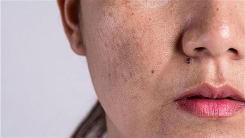 تعرف على أسباب ظهور الطفح الجلدي على الوجه