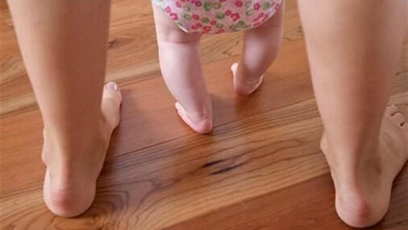 ما هي أسباب تقوس الساقين عند الأطفال؟