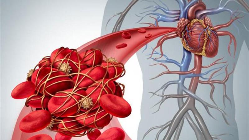 طبيبة تكشف الأعراض الأولى لتجلط الدم