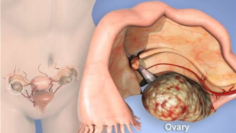 باحثون يتمكنون من تحديد أصل سرطان المبيض