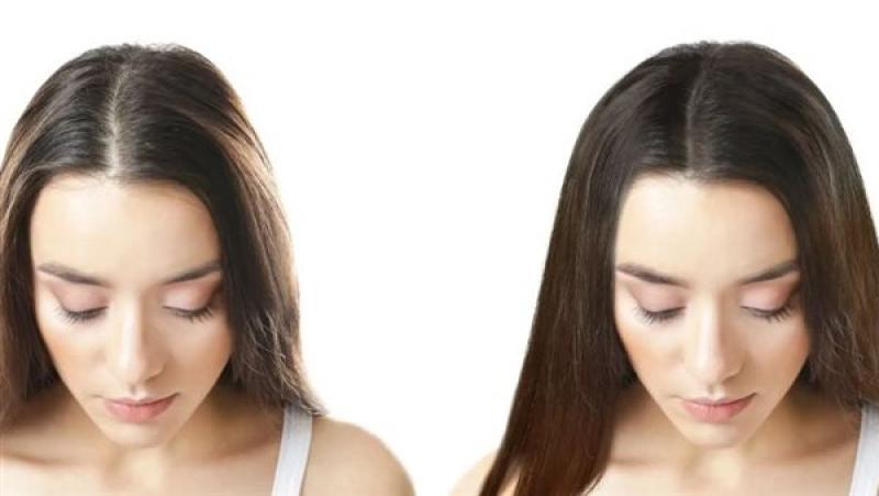 التطورات الحديثة في زراعة الشعر| من تقنيات FUE إلى الخلايا الجذعية