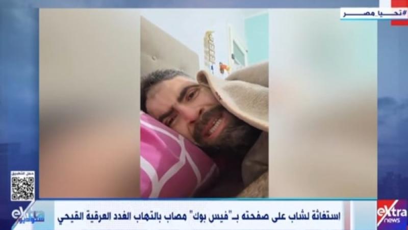 مصاب بالتهاب الغدد العرقية.. الصحة تستجيب لشاب بعد استغاثته عبر فيس بوك