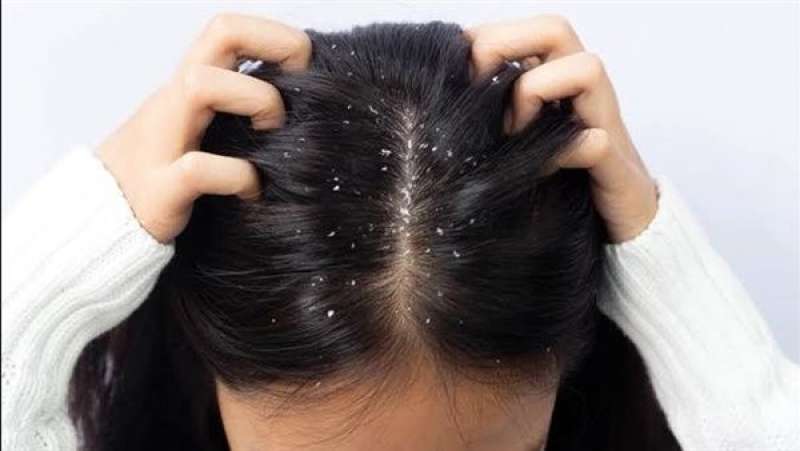 تخلصي من قشرة الشعر نهائيًا بمكونات طبيعية متوفرة في كل منزل