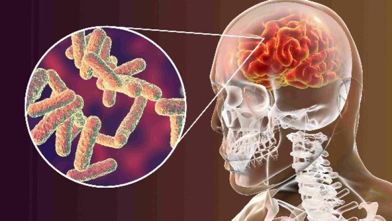 معلومات تهمك.. اعرف أعراض الالتهاب السحائي