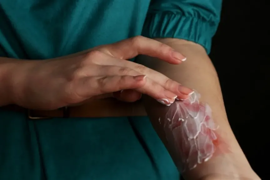 هبة السويدي: استيراد الجلد الطبيعي من الخارج ساهم في رفع نسبة النجاة من الحروق