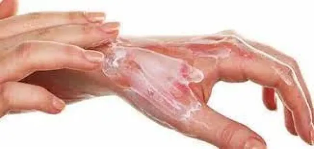 لا يُسبّب تشوهات | «الصحة»: مصر الأكثر إصابة بالحروق .. والتبرع بالجلد يكون بالطبقة السطحية