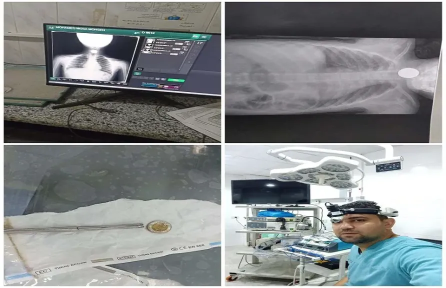 تدخل عاجل يُنقذ طفلين شقيقين من الاختناق بمستشفى السنبلاوين العام