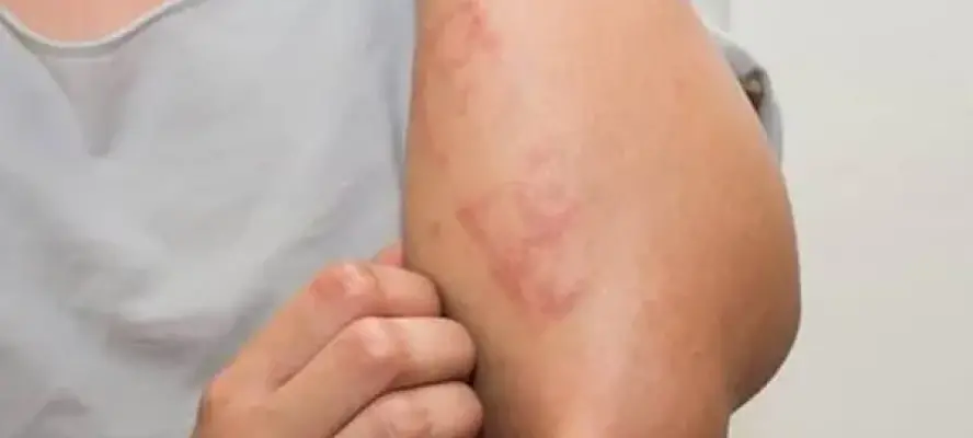 طبيبة توضح أعراض حساسية الشمس وطرق الوقاية منها