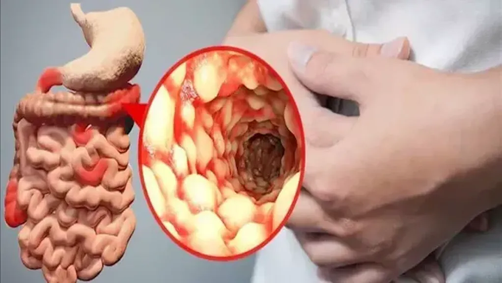 خبراء يكشفون غذاء مفاجئ يساعد في تهدئة التهاب الأمعاء