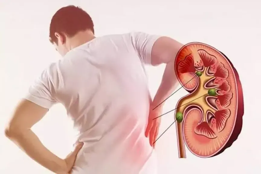 آلام الظهر قد لا تكون السبب.. علامات تكشف الإصابة بحصوات الكلى