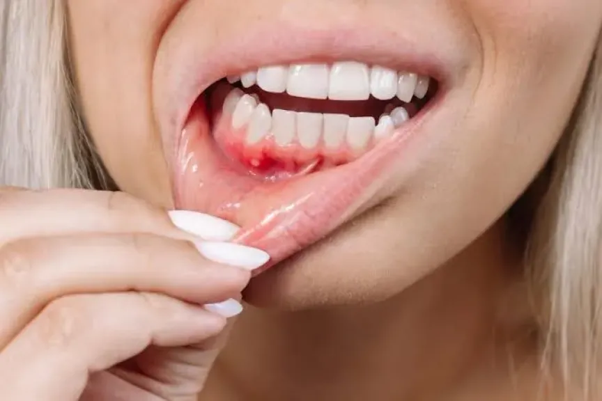 حلوى مبتكرة قد تدعم صحة الفم وتساعد في الوقاية من أمراض اللثة